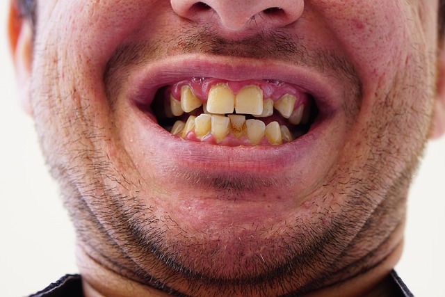 Tandretning med Invisalign